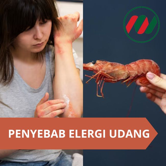 Alergi Udang: Penyebab Serta Gejalanya